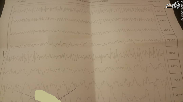 نوار مغزی گران&zwnj;ترین کلاه بر سر بیماران از همه جا بی&zwnj;خبر!